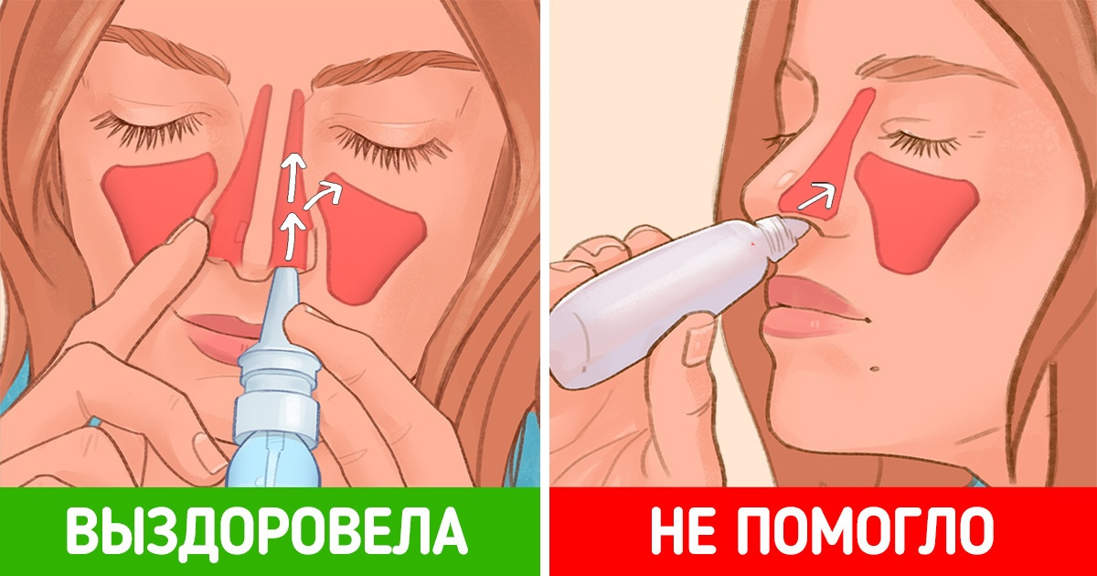 Как правильно использовать спрей для носа